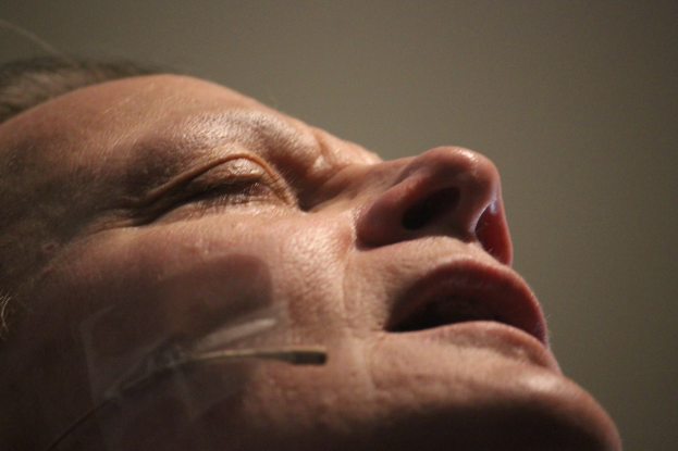 Nahaufnahme eines Frauengesichts mit geschlossenen Augen während einer Gesichtsstraffungsprozedur, mit mehreren Nadeln in der Nase und einer Wand im Hintergrund.